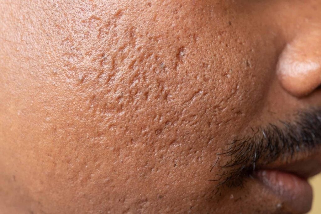 Acne Scarring