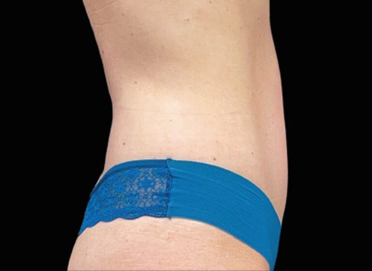 The same side view after EmSculpt Neo, with a flatter profile through the lower abdomen