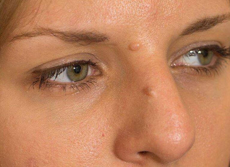 Side of the nose before treatment, with a small raised lesion near the eye