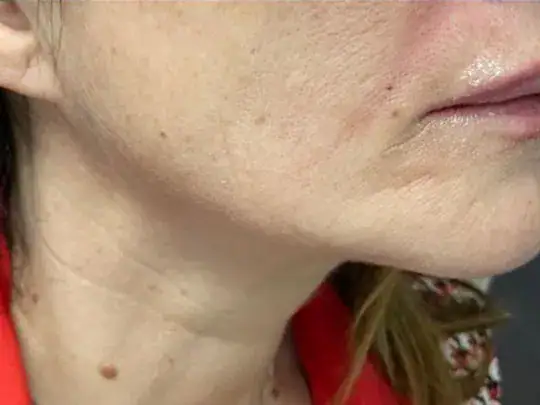 After Endolift: the same jawline appearing firmer and more defined.