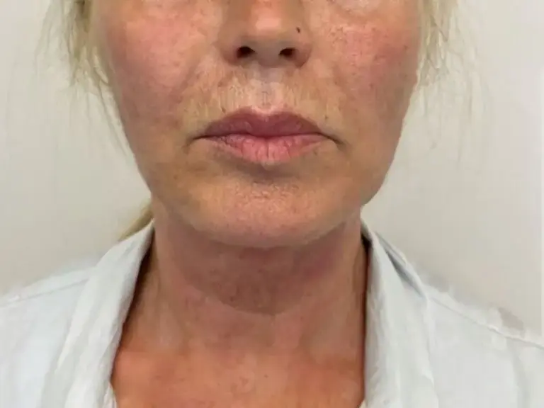After Endolift: the same neck and jawline looking smoother and firmer.