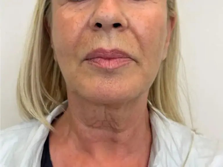 Before Endolift: front view of the lower face and neck showing loose skin and neck lines.